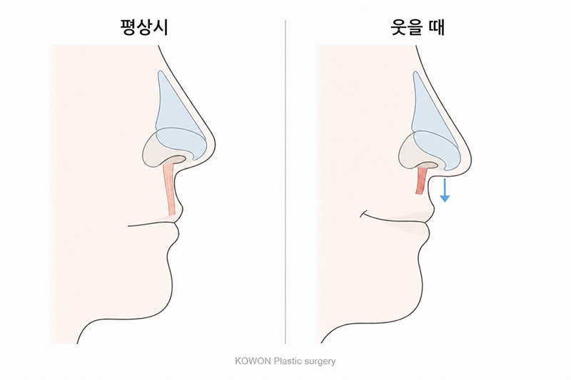 매부리코수술 방법, 코끝처짐 원인과 근육교정까지 사진 5
