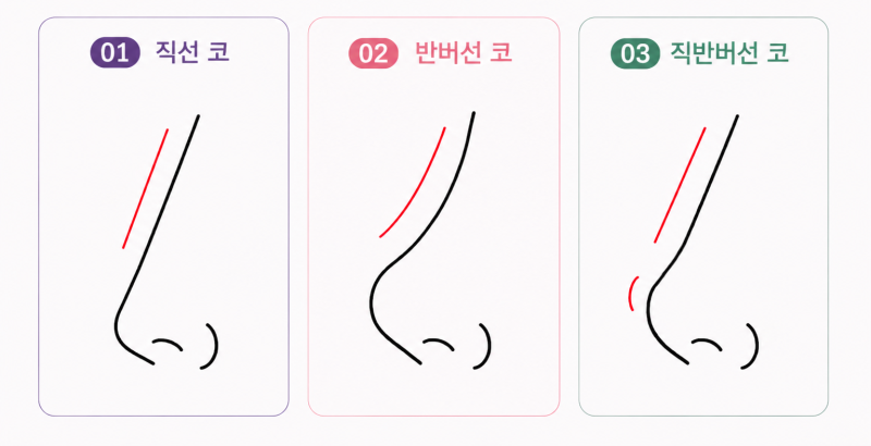 강남 자려한코 성형, 직반라인과 코끝 콧대 모양의 차이